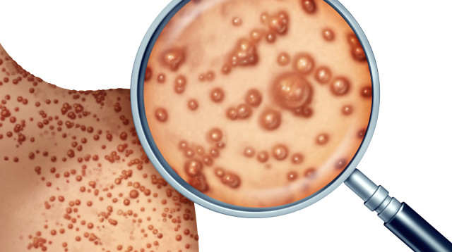 אבעבועות הקוף. לרוב ביחסי מין בין גברים (צילום: אינגאימג')