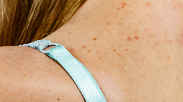 פצעי חום (צילום: אינגאימג)