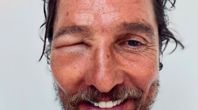 מת'יו מקונוהיי לאחר עקיצת הדבורה (צילום: צילום מסך אינסטגרם)