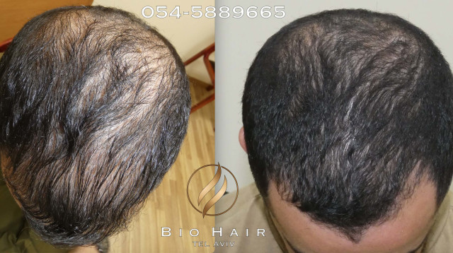 הקרב על השיער (צילום: BioHair )