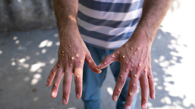  אבעבועות הקוף. משלפוחיות למחלה קטלנית (צילום: iStock)