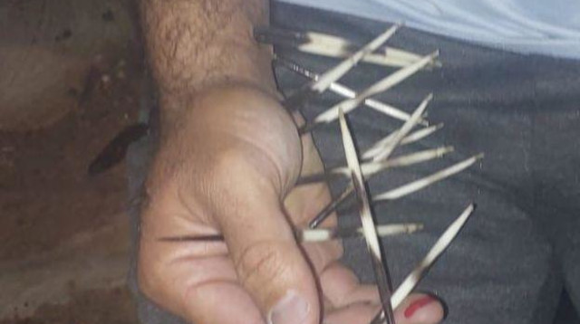 ידו של המטופל עם קוצי הדורבן. מזיהומים ועד סכנת חיים (צילום: דוברות בית החולים זיו בצפת)