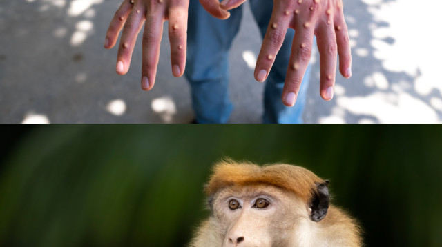 אבעבועות הקוף. זן חדש וקטלני  (צילום: iStock)