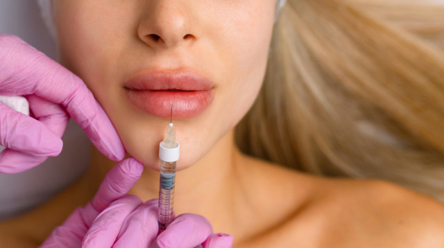 מילוי שפתיים (צילום: שאטרסטוק)