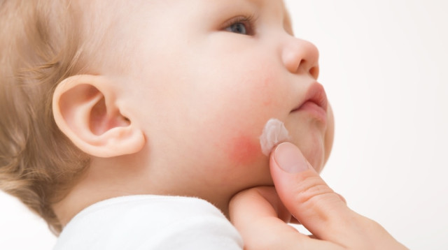 אימפטיגו. הטיפול הראשוני הוא במשחה אנטיביוטית (צילום: שאטרסטוק)