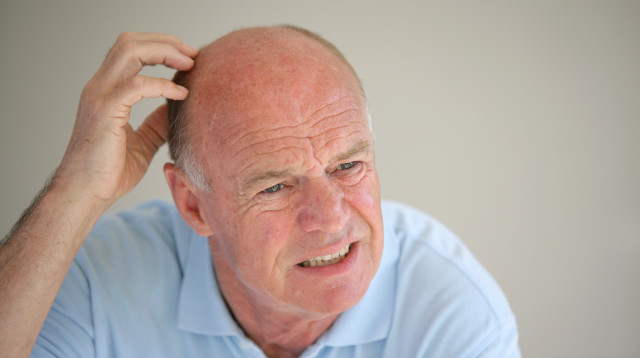 התקרחות (צילום: אינג'אימג')