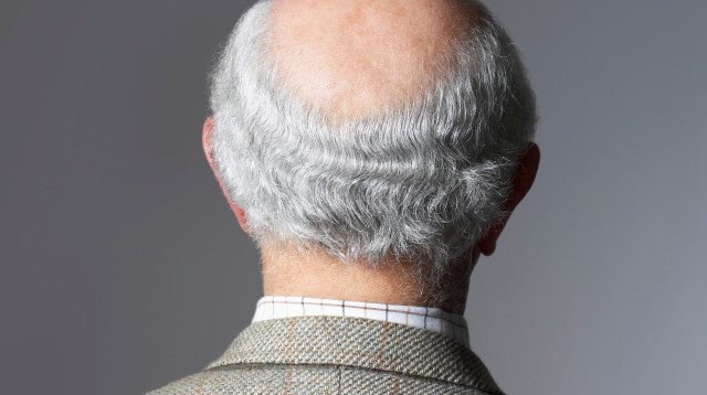 האם אתם הולכים להקריח? כך תגלו זאת (צילום: אינגאימג')