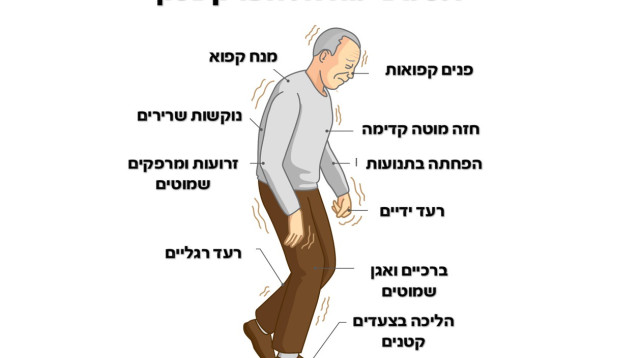תסמיני מחלת הפרקינסון. רעד ונוקשות (צילום: שאטרסטוק)