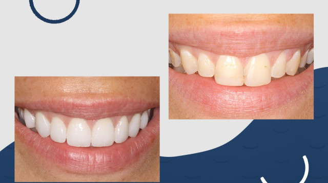 ד"ר רוני אמיד רופא שיניים - ציפוי חרסינה, כתרי חרסינה, כתרי זירקוניה (צילום: יחצ)