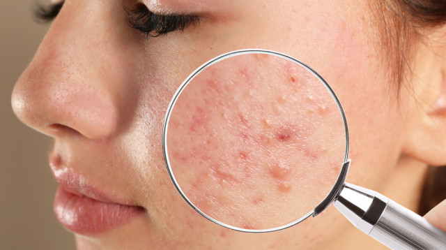 אקנה (צילום: אינג'אימג')