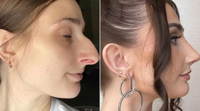 דווין אייקן, לפני ואחרי (צילום: צילום מסך,SWNS)