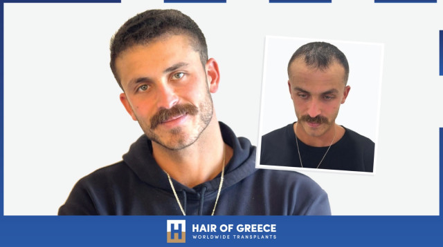 “6 חודשים אחרי: כך שינתה השתלת שיער באתונה את חייו של אופק ברמן” (צילום: יחצ)