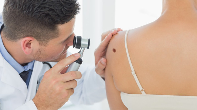 בדיקת שומות חשודות. אחת לשנה אצל רופא העור (צילום: שאטרסטוק)