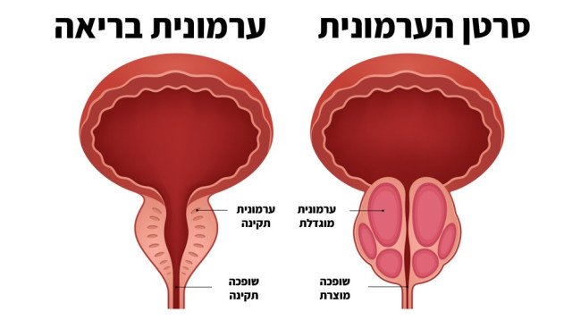 סרטן ערמונית (צילום: איור: מעריב אונליין)