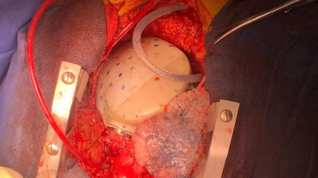 הלב המלאכותי. גשר של שנתיים (צילום: באדיבות הדסה)