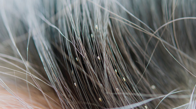 כינים (צילום: אינג'אימג')