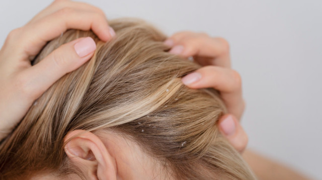 סבוריאה בקרקפת – מה גורם לה ואיך אפשר להיפטר ממנה? (צילום: FREEPIK)