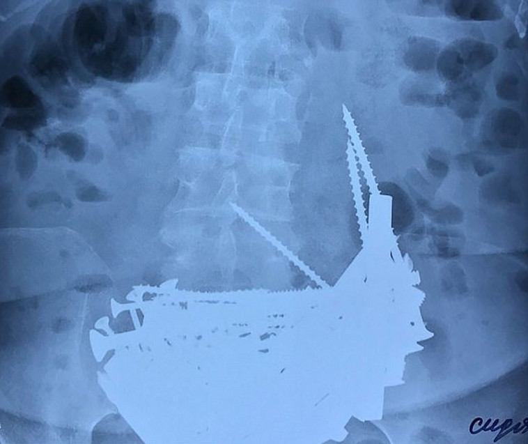 צילום הרנטגן של בטנה של נינה. צילום מסך