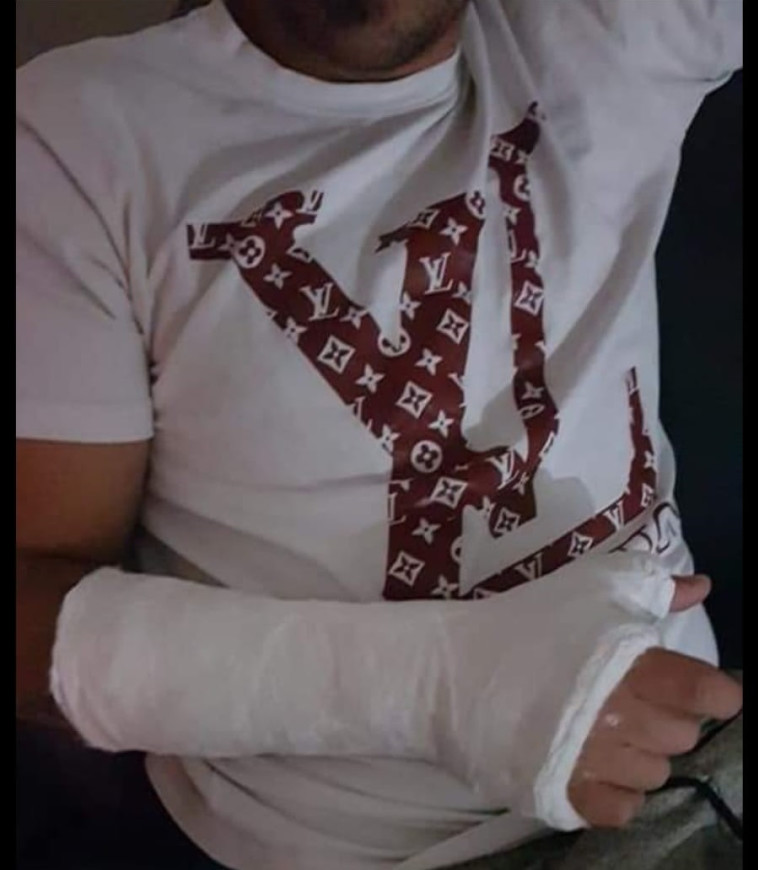 ידו המגובסת של לירן סופר. &quot;לא יכול לפתוח את העסק, זו פגיעה בפרנסה שלי&quot;. צילום מסך