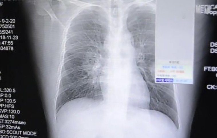 צילום הריאות של פאנג. דרך כלי התקשורת הסיניים