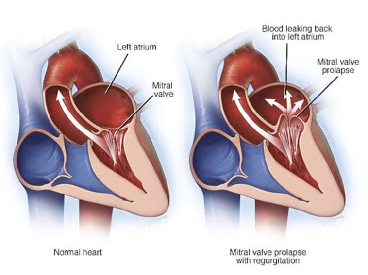 צניחת המסתם המיטרלי