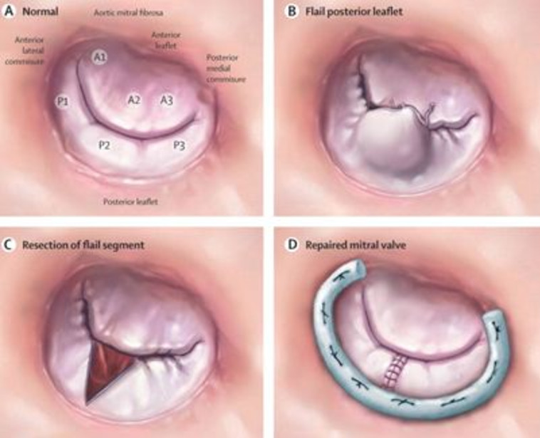 מסתם תקין (שמאלית עליונה), צניחת העלה האחורי (ימנית עליונה), חיתוך הרקמה העודפת (שמאלית תחתונה) ומסתם מתוקן