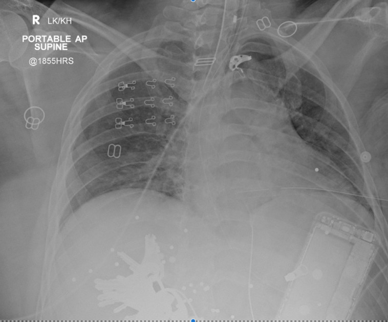 Canadian Journal of Anesthesia :צילום נטגן של האישה הפצועה. צילום