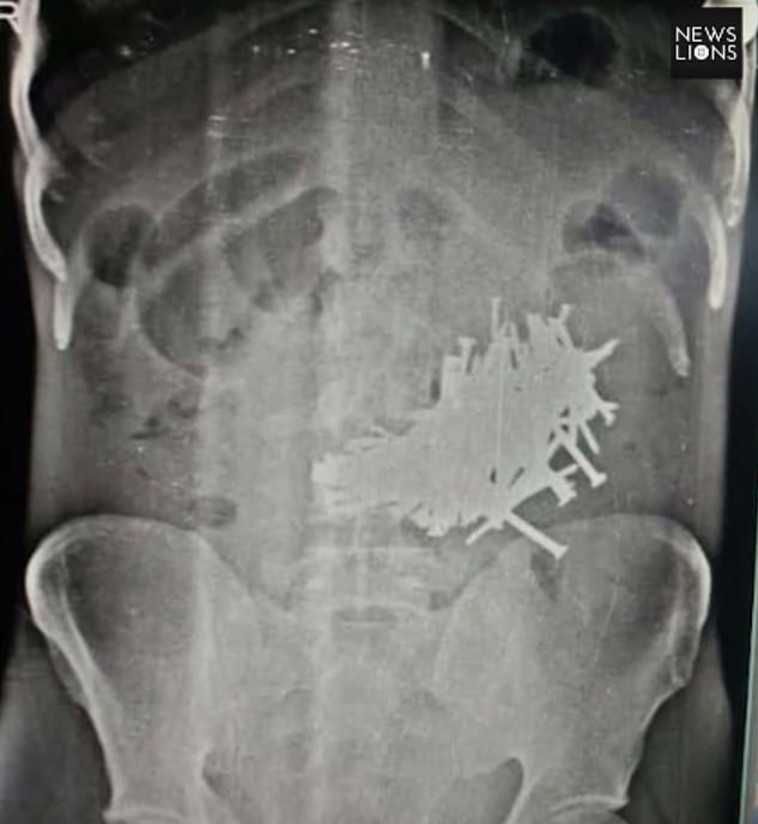 צילום הרנטגן שחשף את המסמרים בבטנו. צילום: כלי התקשורת המקומיים