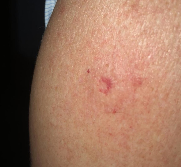 הפציעה מירי כדור האיירסופט באירוע של כחול לבן, באדיבות המצולם