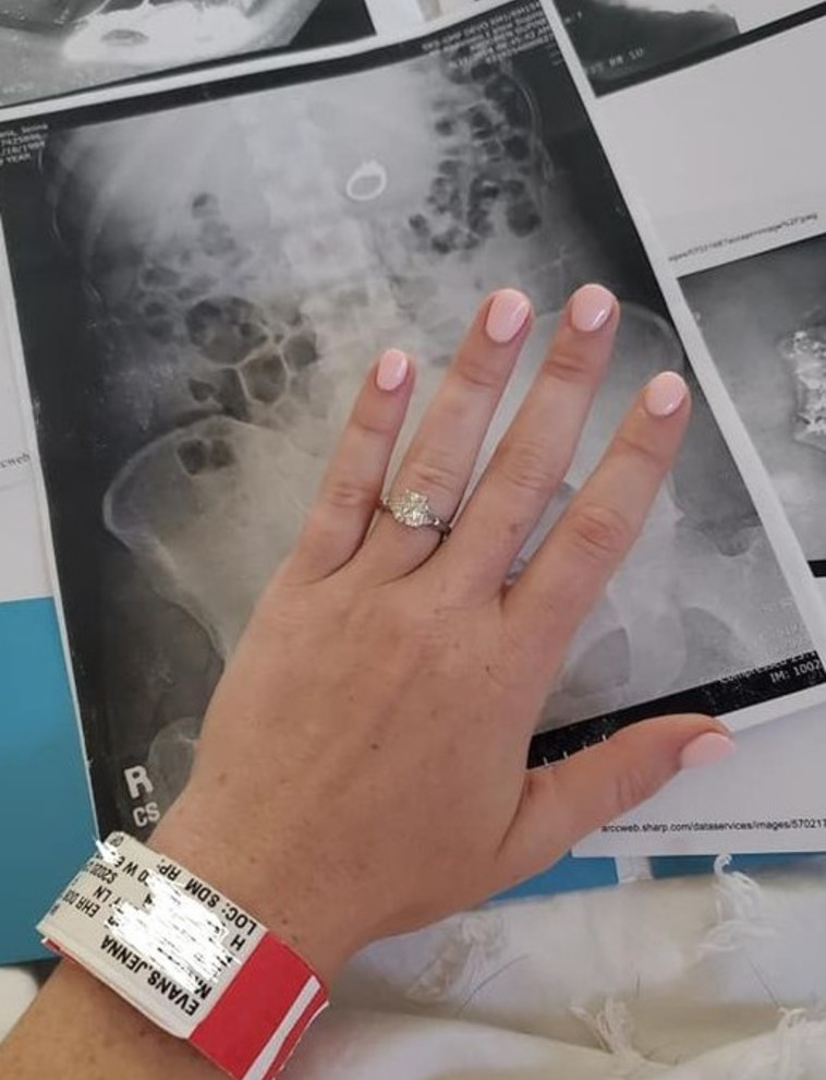 טבעת האירוסים וצילום הרנטגן