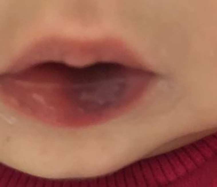 הפציעות שנגרמו לבתה של בן חמו. צילום פרטי