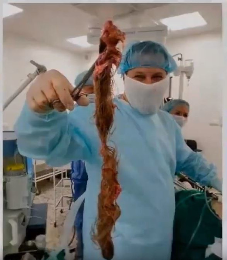 הגוש השיער שהוסר משחלותיה של הצעירה(צילום: צילום מסך יוטיוב)