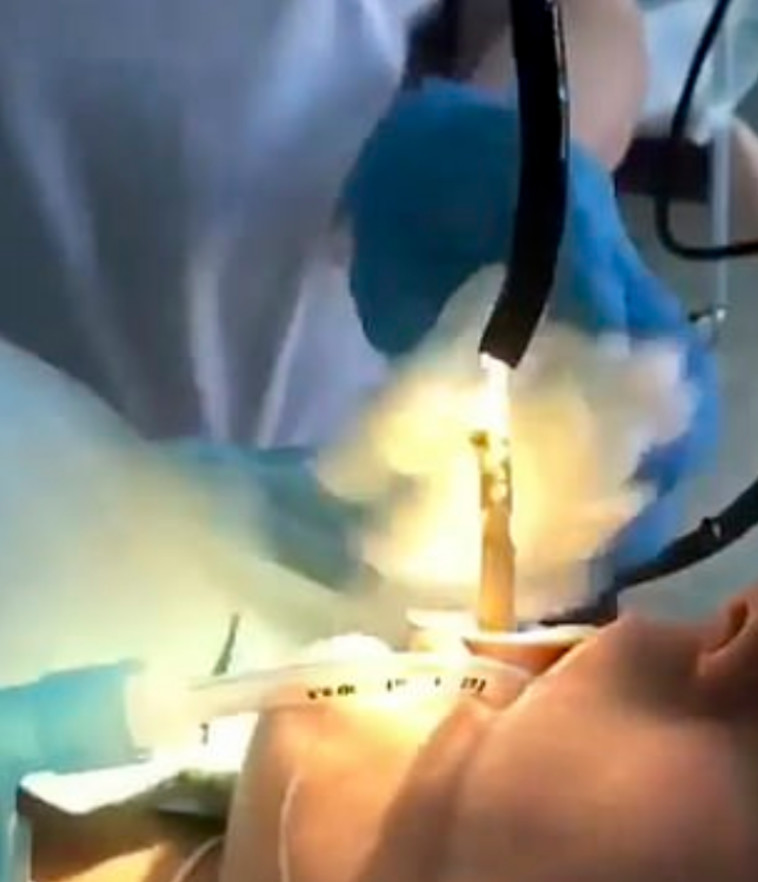 רגע יציאת הנחש מפי אישה 