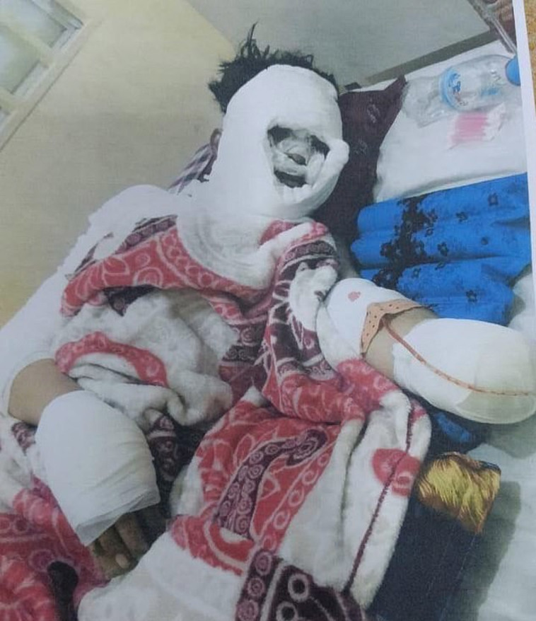 האישה שהותקפה בחומצה