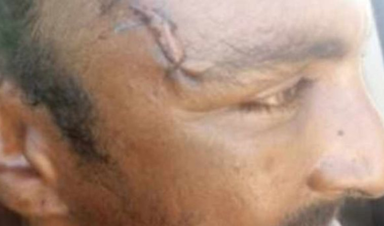 הצלקת שנותרה כתוצאה מהתקיפה