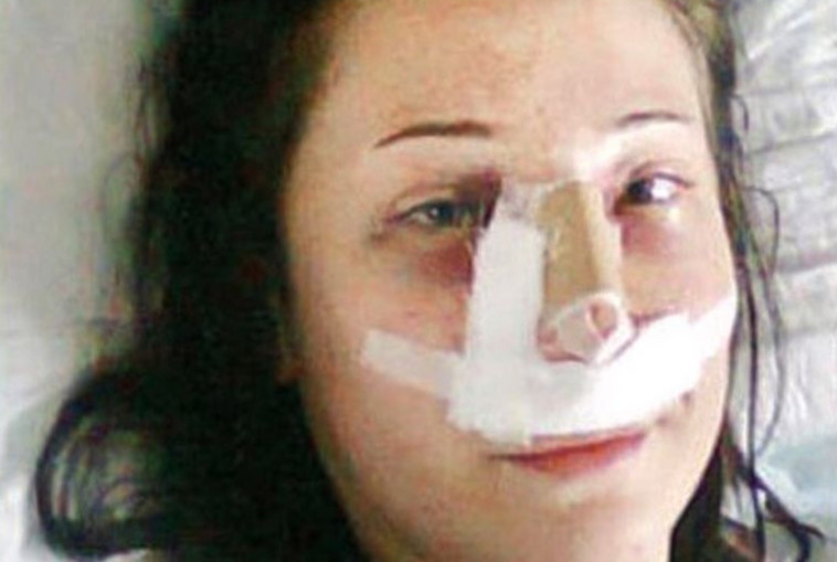 צ'ליק אחרי הניתוח אף