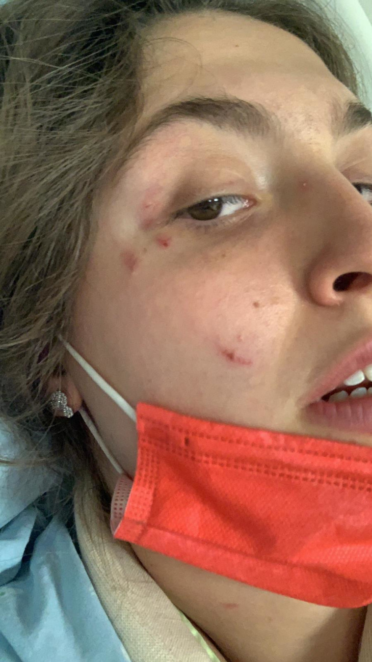 הצעירה שהותקפה על ידי פיטבול