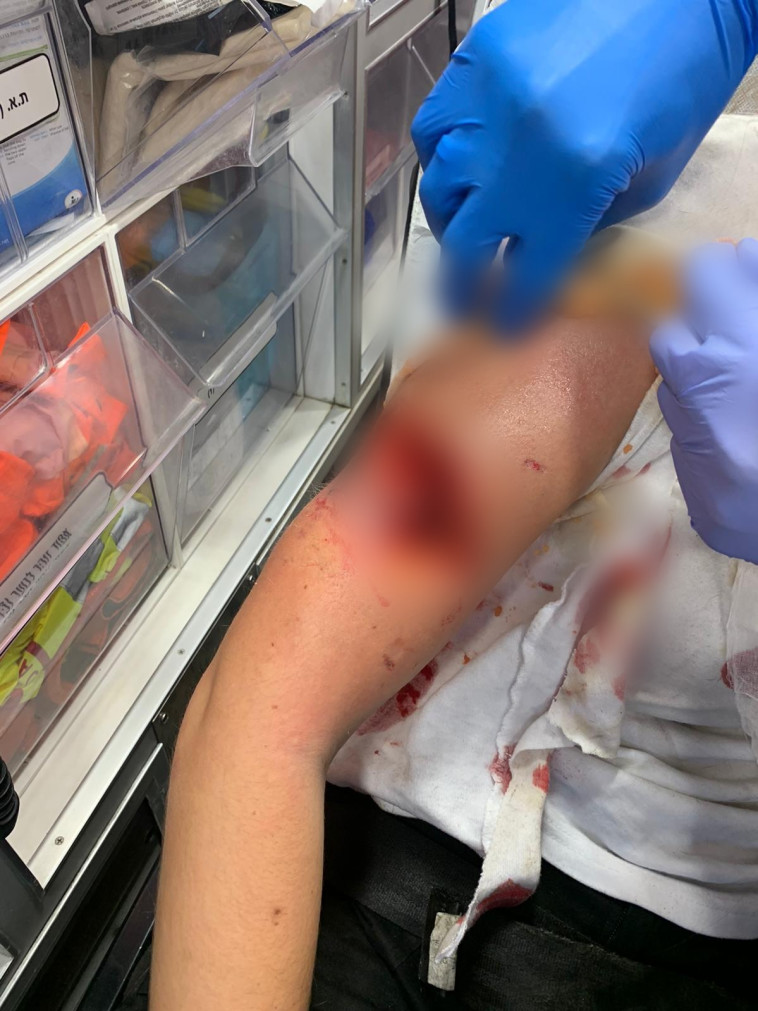 שחר נפצעה כשננשכה על ידי פיטבול