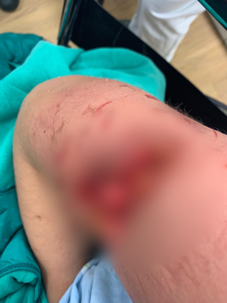 שחר נפצעה כשננשכה על ידי פיטבול