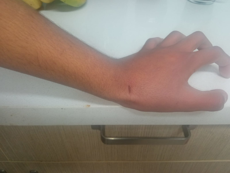 הנזק שנגרם לעציר