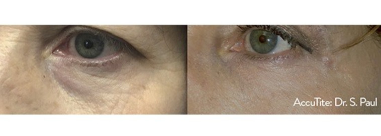 לפני ואחרי AccuTite - צילום: Dr.-Sean-Paul