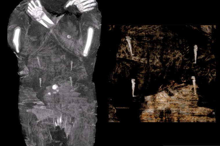 צילום הרנטגן של המומיה