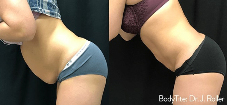 BodyTite - לפני ואחרי  (צילום: Roller)