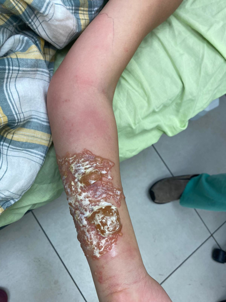 עקיצת מדוזה