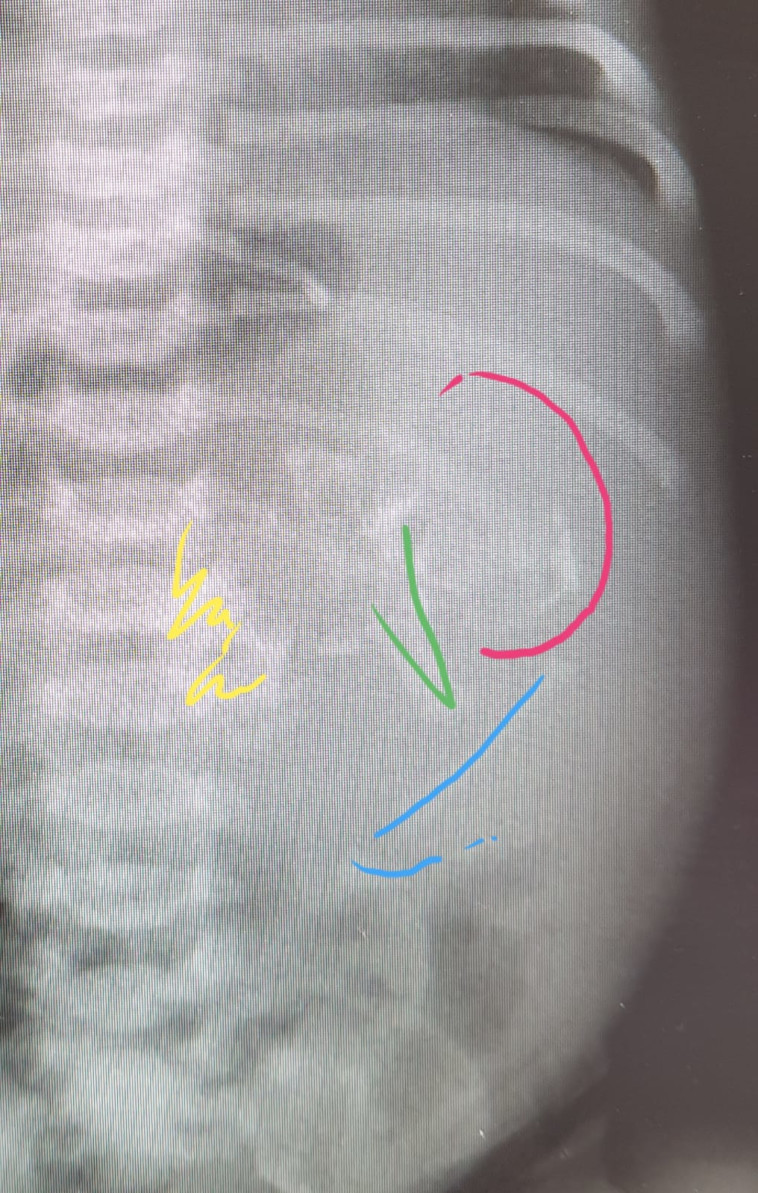 העובר שנמצא בבטנה של התינוקת