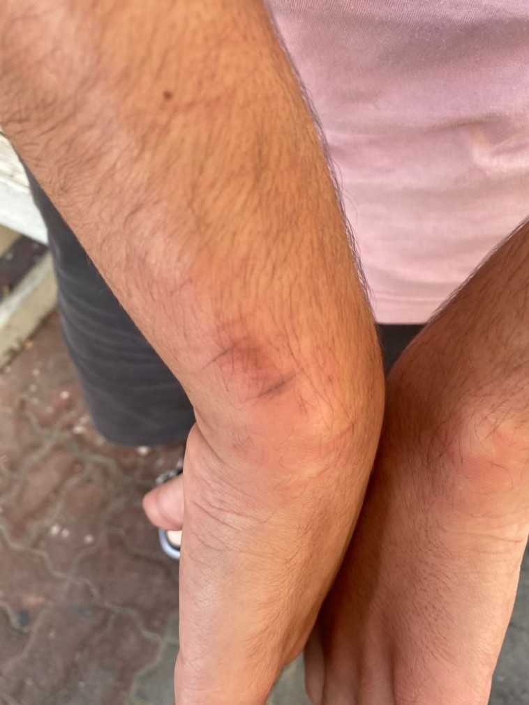 ידיו של החייל שהוכה