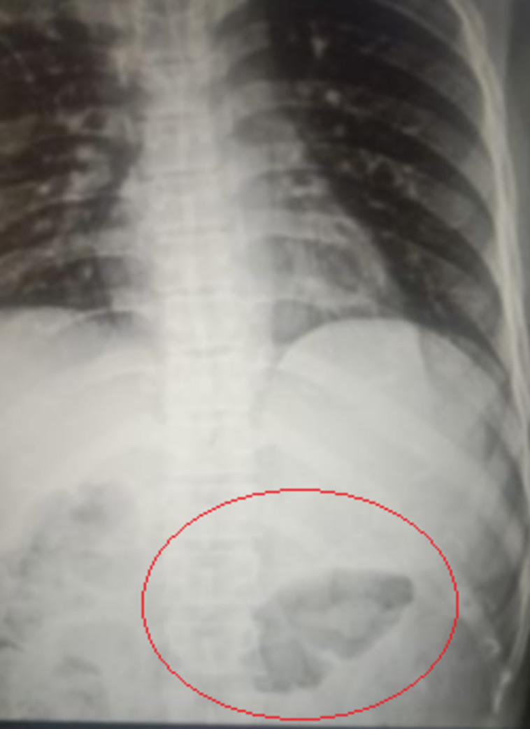 הקליע בצילום הרנטגן