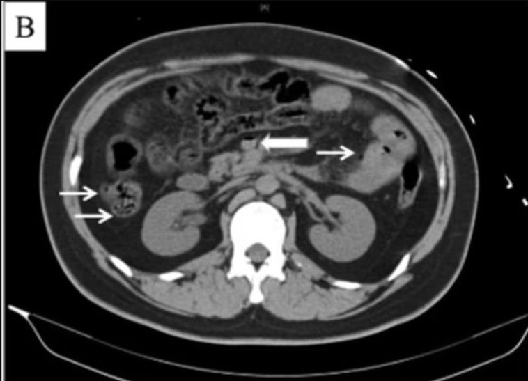צילום ה-CT של המטופל - B