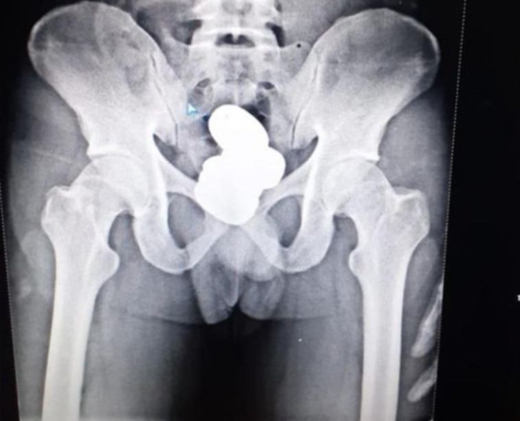 מטילי הזהב בבטנו של המבריח