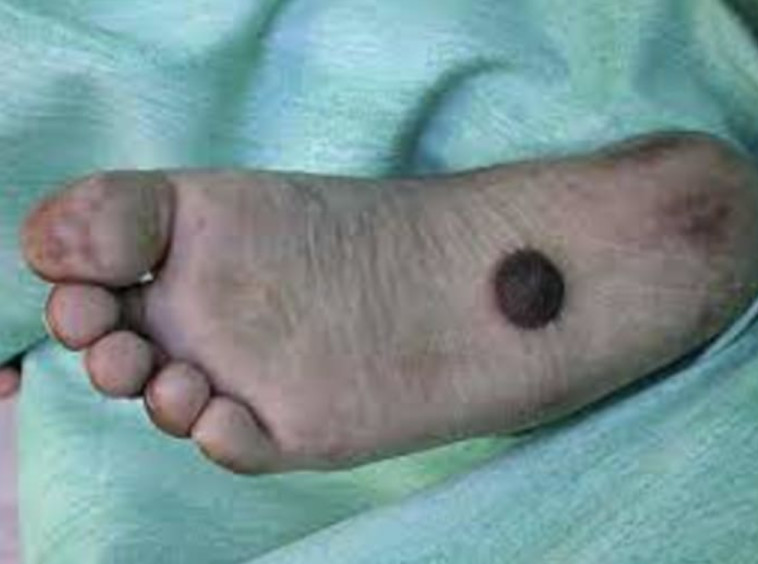 קשה לצפייה: פטמה שגדלה על כף רגל